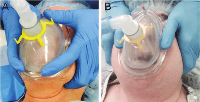 intubacao orotraqueal - mednobel